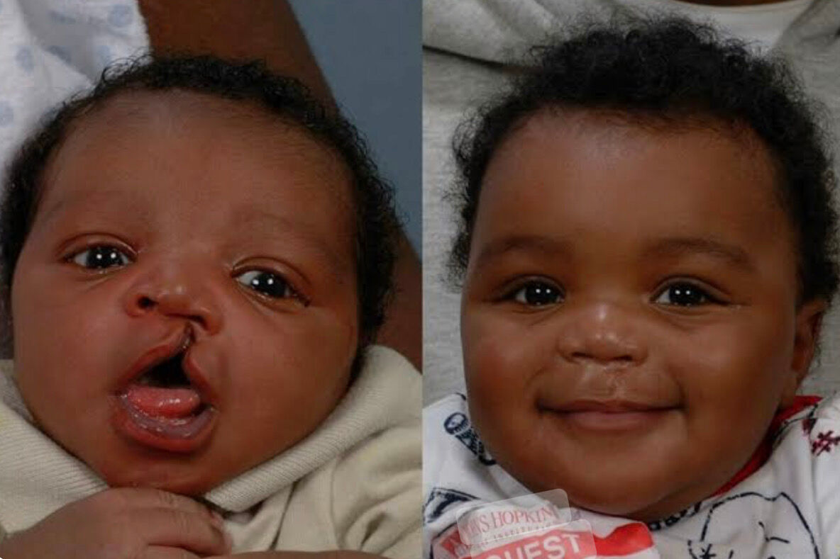 Combined image showing a child's cleft lip before and after surgical repair